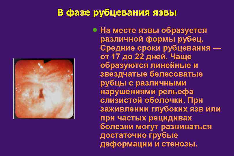 В фазе рубцевания язвы · На месте язвы образуется различной формы рубец. Средние сроки