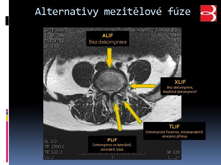 Alternativy mezitělové fúze ALIF Bez dekomprese XLIF Bez dekomprese, Nepřímá dekomprese? TLIF PLIF Dekomprese