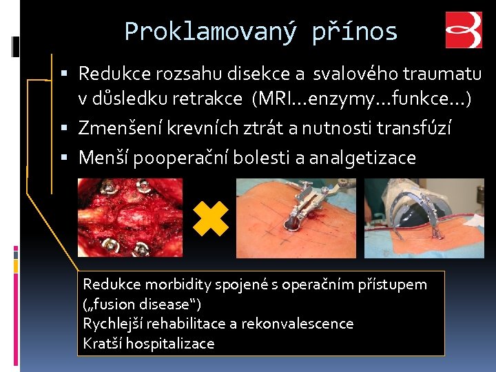 Proklamovaný přínos Redukce rozsahu disekce a svalového traumatu v důsledku retrakce (MRI…enzymy…funkce…) Zmenšení krevních