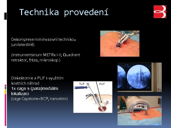 Technika provedení Dekomprese miniinvazivní technikou (unilaterálně) (instrumentarium METRx I-II, Quadrant retraktor, fréza, mikroskop )