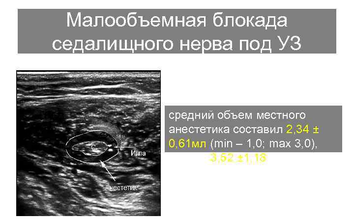 Малообъемная блокада седалищного нерва под УЗ средний объем местного анестетика составил 2, 34 ±