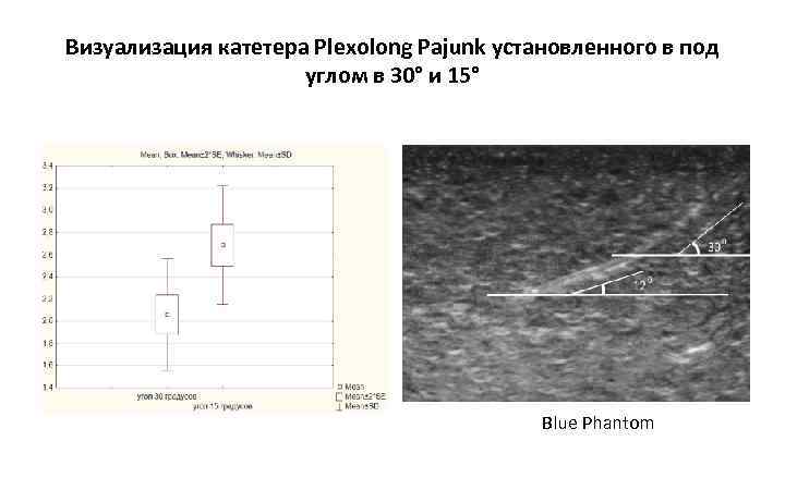 Визуализация катетера Plexolong Pajunk установленного в под углом в 30° и 15° Blue Phantom