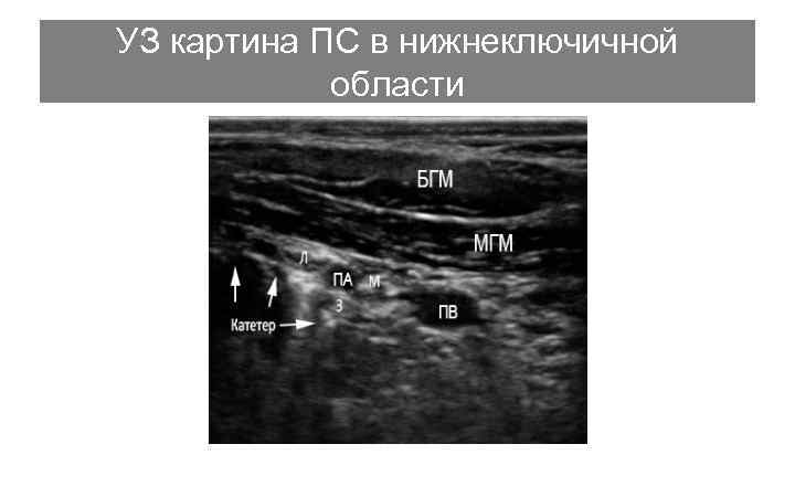 УЗ картина ПС в нижнеключичной области 