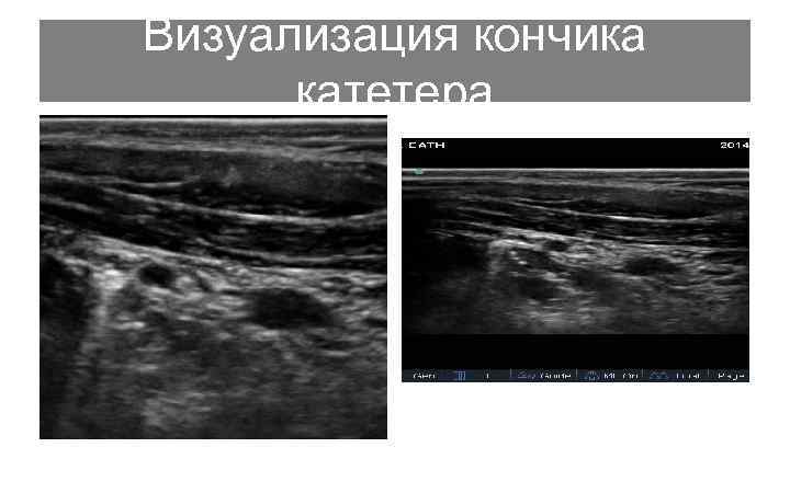 Визуализация кончика катетера 