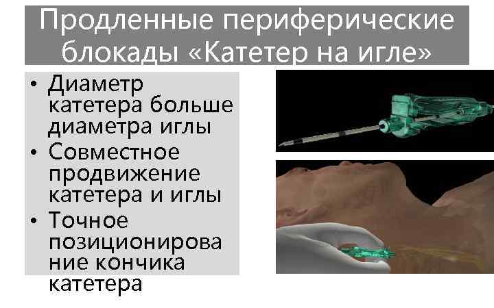 Продленные периферические блокады «Катетер на игле» • Диаметр катетера больше диаметра иглы • Совместное