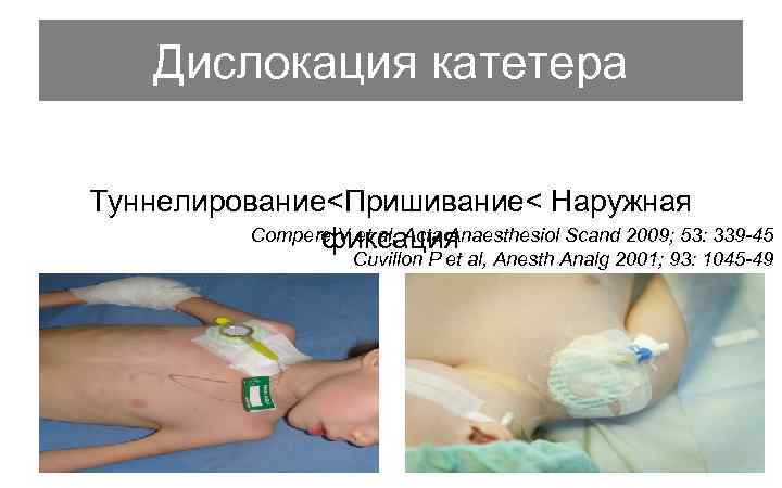 Дислокация катетера Туннелирование<Пришивание< Наружная Compere V et al, Acta Anaesthesiol Scand 2009; 53: 339