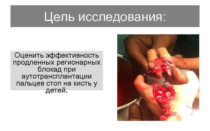 Цель исследования: Оценить эффективность продленных регионарных блокад при аутотрансплантации пальцев стоп на кисть у