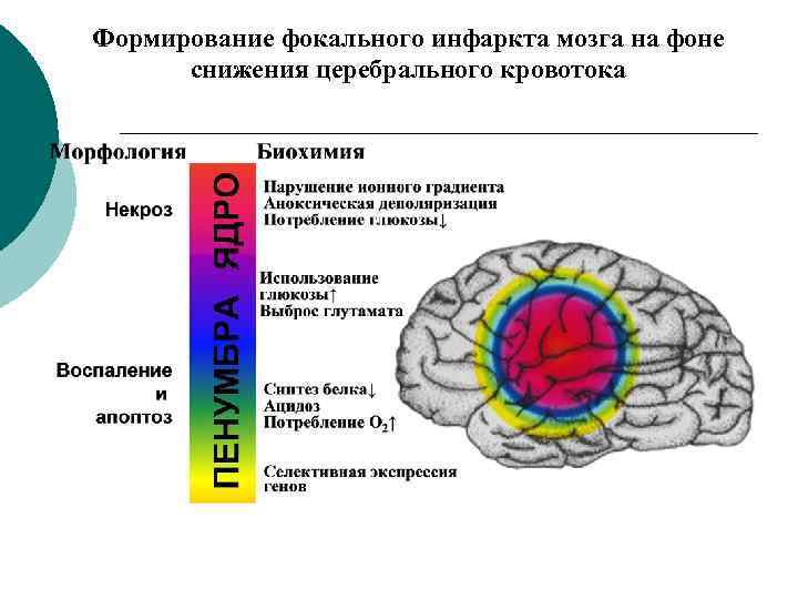 Последствия инфаркта мозга