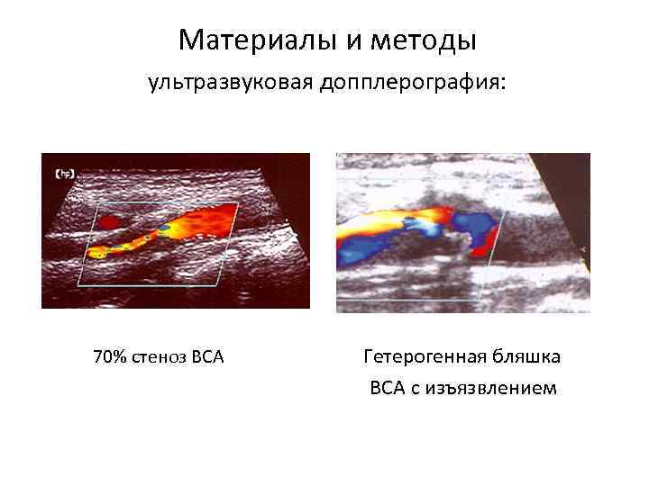 Материалы и методы ультразвуковая допплерография: 70% стеноз ВСА Гетерогенная бляшка ВСА с изъязвлением 