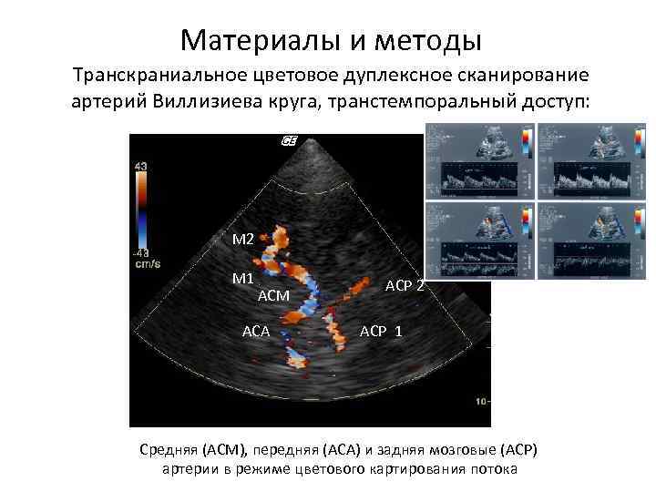 Материалы и методы Транскраниальное цветовое дуплексное сканирование артерий Виллизиева круга, транстемпоральный доступ: M 2