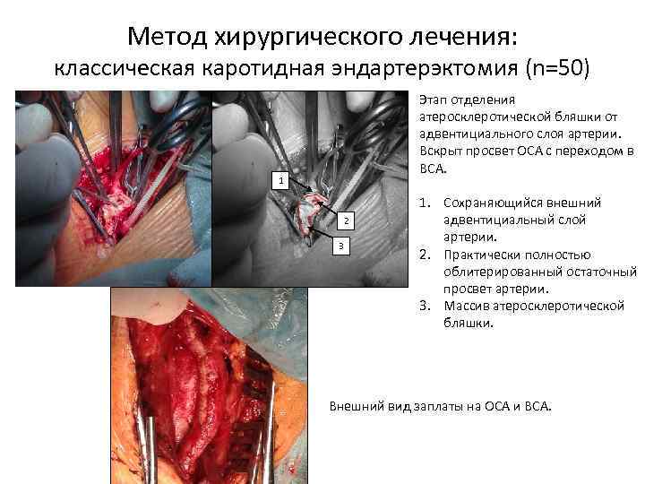 Метод хирургического лечения: классическая каротидная эндартерэктомия (n=50) Этап отделения атеросклеротической бляшки от адвентициального слоя