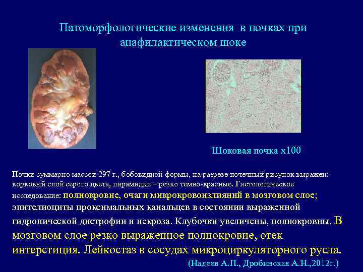 Патоморфологические изменения в почках при анафилактическом шоке Шоковая почка х100 Почки суммарно массой 297
