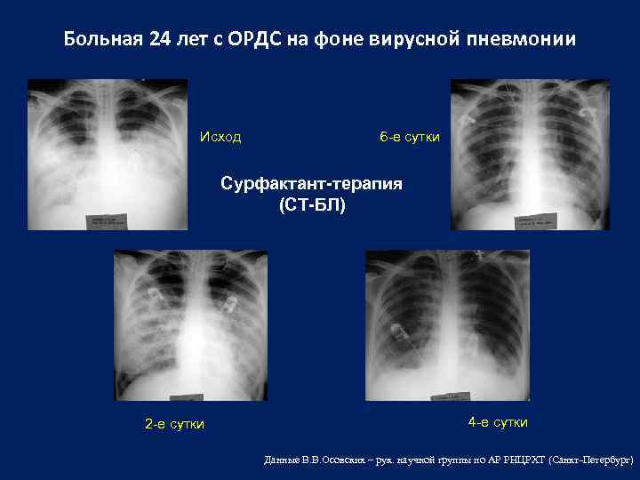 Пневмония на фоне коклюша