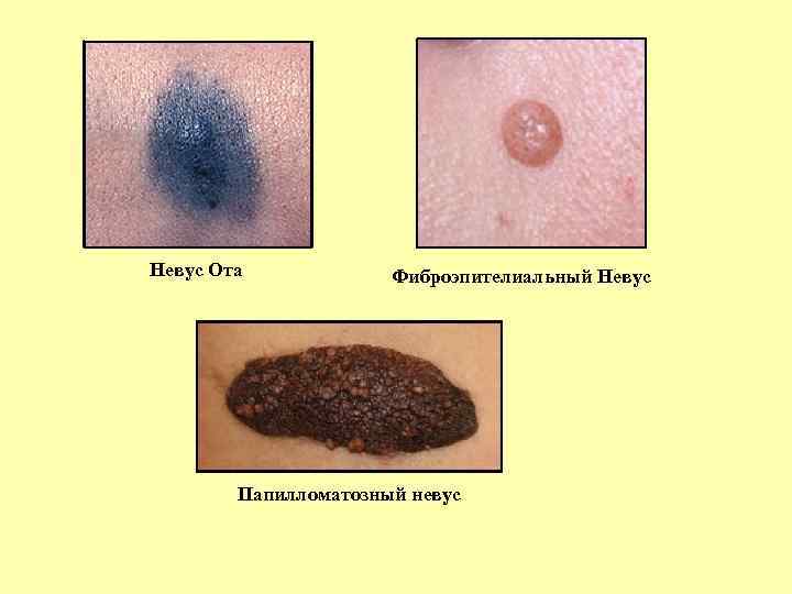 Невус Ота Фиброэпителиальный Невус Папилломатозный невус 
