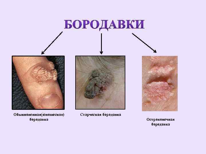 Обыкновенная(юношеская) бородавка Старческая бородавка Остроконечная бородавка 