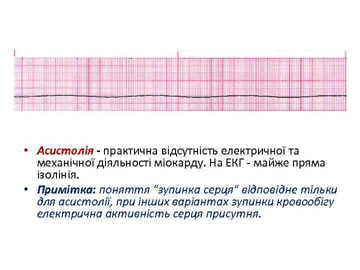  • Асистолія - практична відсутність електричної та механічної діяльності міокарду. На ЕКГ -