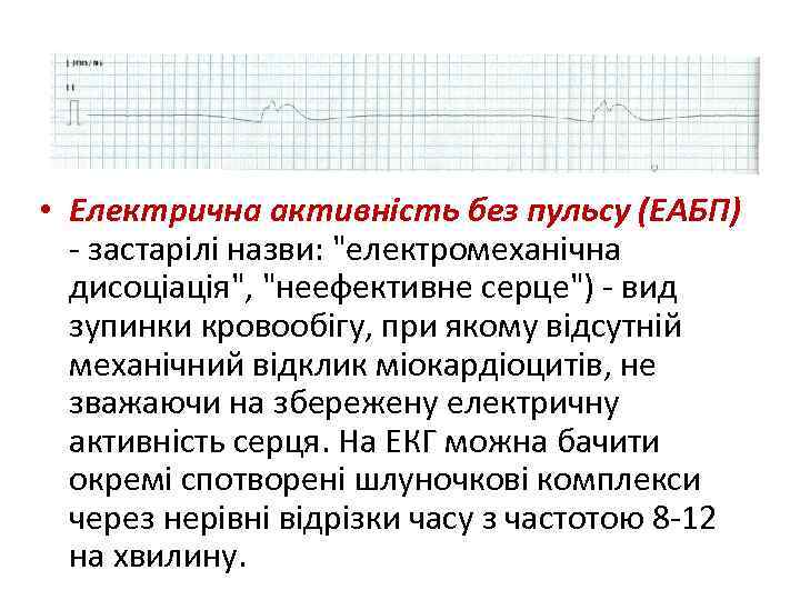  • Електрична активність без пульсу (ЕАБП) - застарілі назви: 