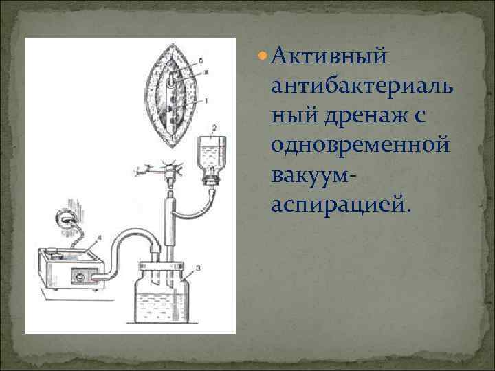  Активный антибактериаль ный дренаж с одновременной вакуумаспирацией. 