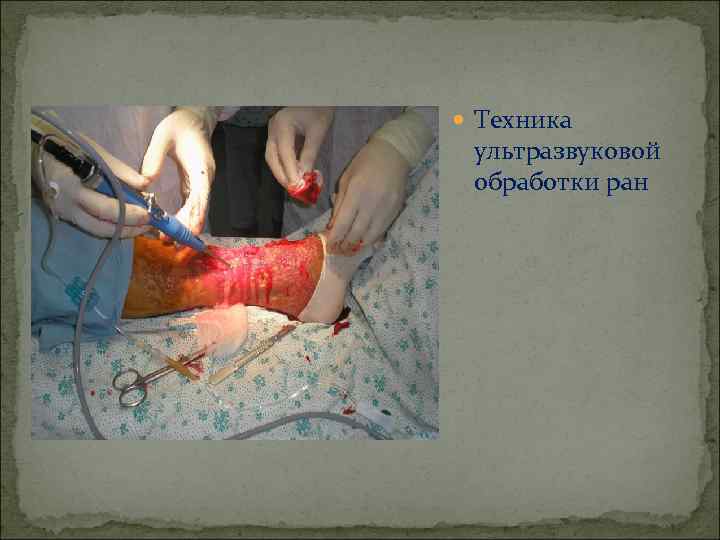  Техника ультразвуковой обработки ран 