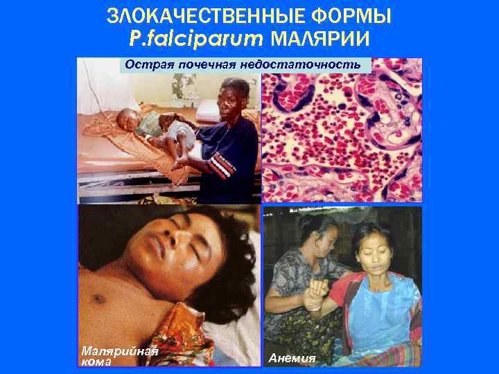 ЗЛОКАЧЕСТВЕННЫЕ ФОРМЫ P. falciparum МАЛЯРИИ Острая почечная недостаточность Малярийная кома Анемия 