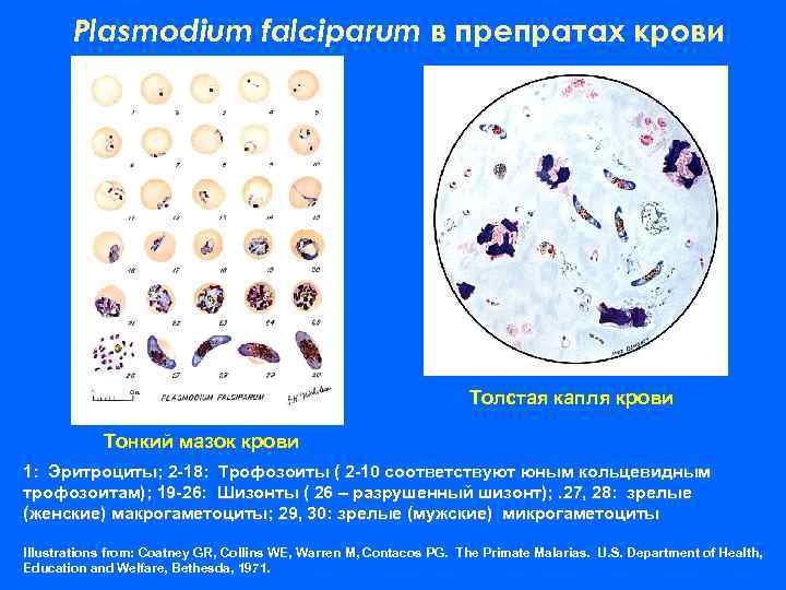 Plasmodium falciparum в препратах крови Толстая капля крови Тонкий мазок крови 1: Эритроциты; 2