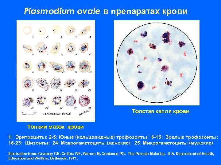 Plasmodium ovale в препаратах крови Толстая капля крови Тонкий мазок крови 1: Эритроциты; 2