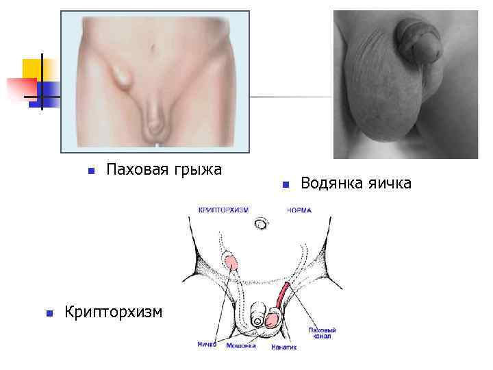 n Паховая грыжа n n Крипторхизм Водянка яичка 