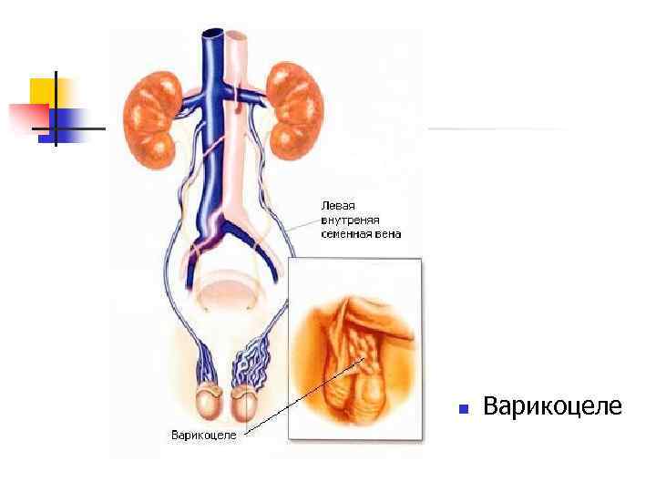 n Варикоцеле 