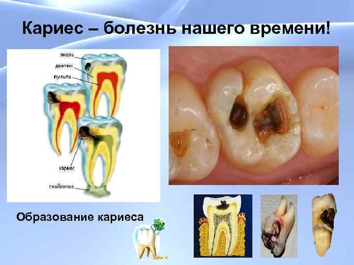 Кариес – болезнь нашего времени! Образование кариеса 