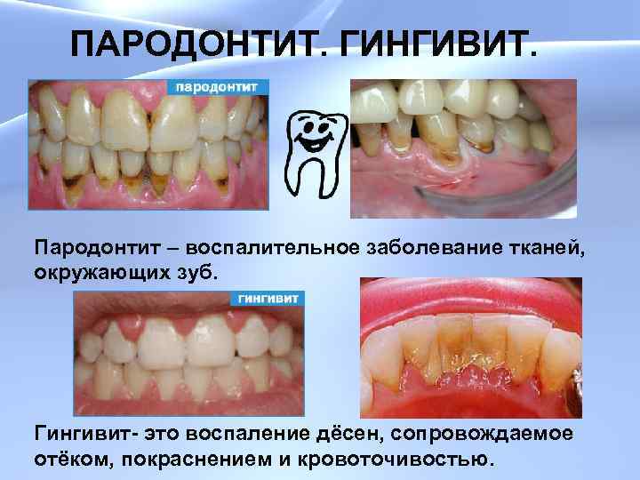 ПАРОДОНТИТ. ГИНГИВИТ. Пародонтит – воспалительное заболевание тканей, окружающих зуб. Гингивит- это воспаление дёсен, сопровождаемое