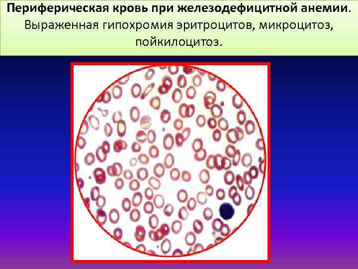 Гипохромия железодефицитная анемия