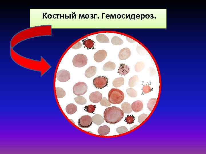 Костный мозг. Гемосидероз. 