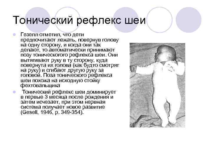 Тонический рефлекс шеи Гезелл отметил, что дети предпочитают лежать, повернув голову на одну сторону,
