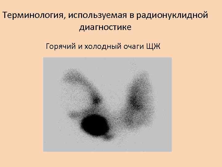 Терминология, используемая в радионуклидной диагностике Горячий и холодный очаги ЩЖ 