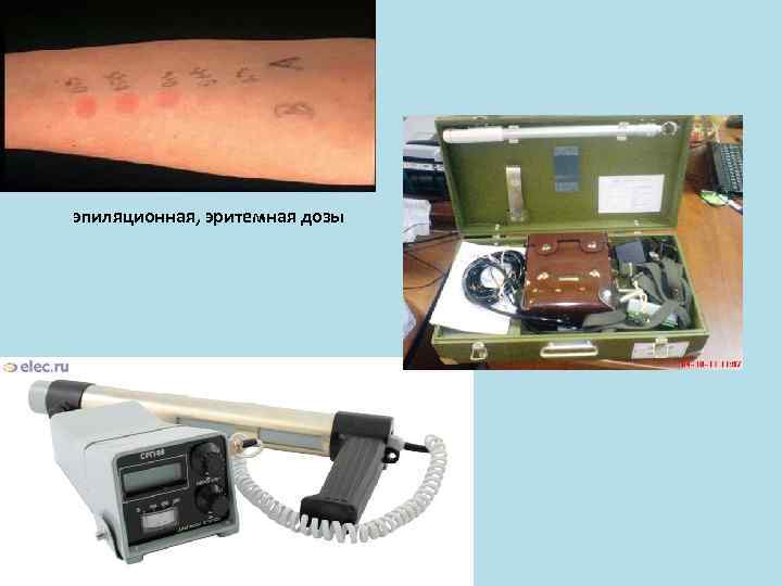 эпиляционная, эритемная дозы 
