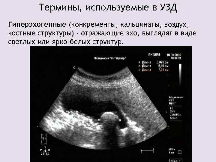 Термины, используемые в УЗД Гиперэхогенные (конкременты, кальцинаты, воздух, костные структуры) - отражающие эхо, выглядят