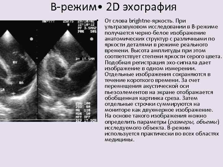 В-режим • 2 D эхография • От слова brightne-яркость. При ультразвуковом исследовании в В-режиме