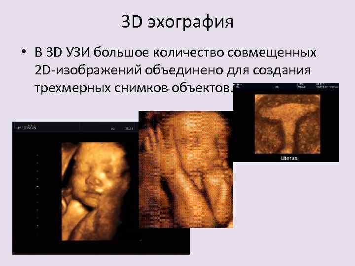 3 D эхография • В 3 D УЗИ большое количество совмещенных 2 D-изображений объединено