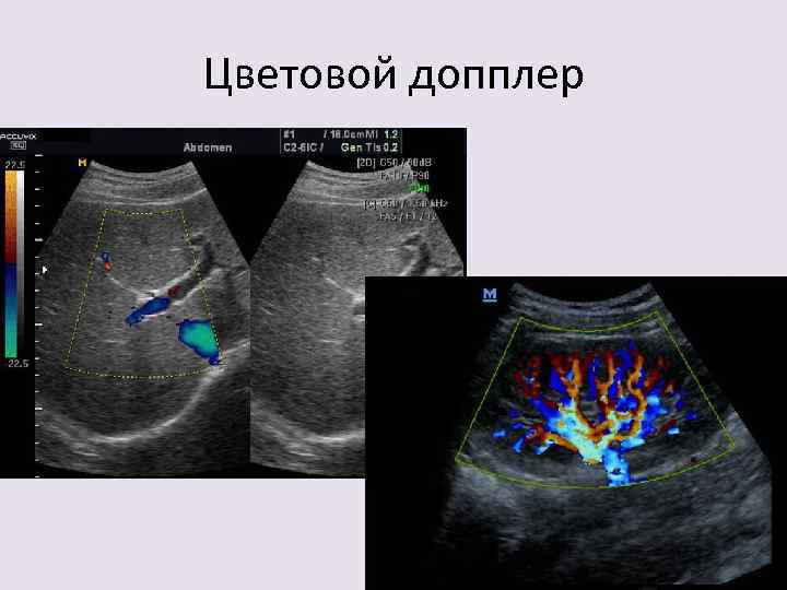 Цветовой допплер 