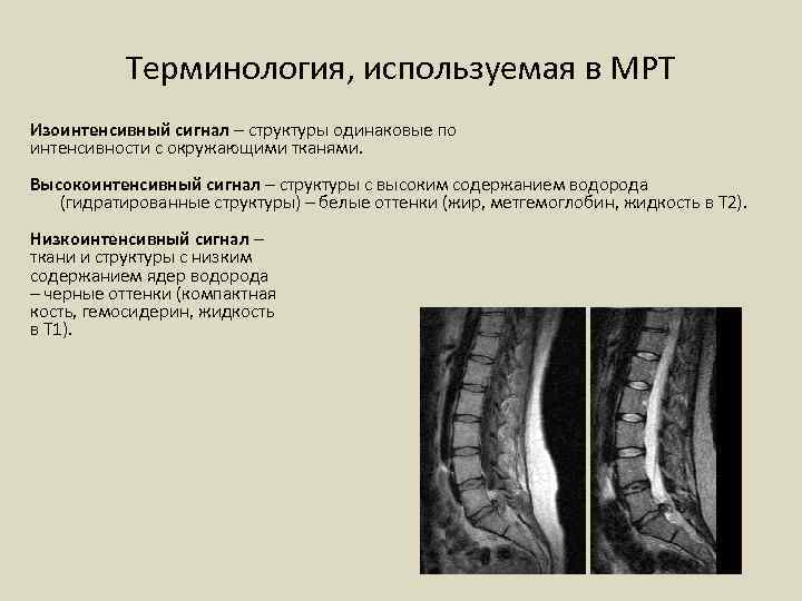 Очаги повышенной интенсивности