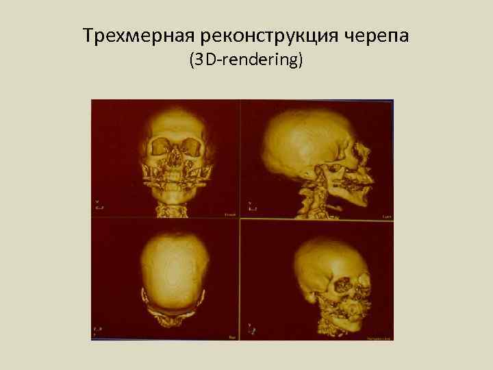 Трехмерная реконструкция черепа (3 D-rendering) 