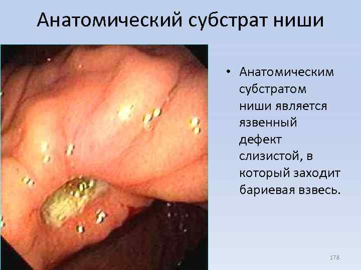 Анатомический субстрат ниши • Анатомическим субстратом ниши является язвенный дефект слизистой, в который заходит