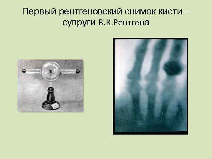 Первый рентгеновский снимок кисти – супруги В. К. Рентгена 