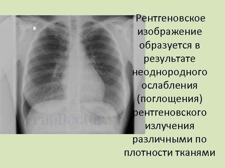 Контрастная чувствительность рентгеновского изображения