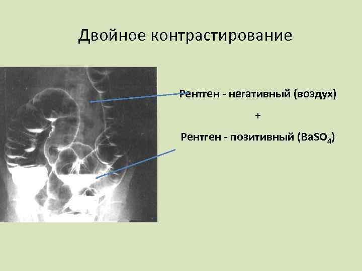 Негативное изображение рентген