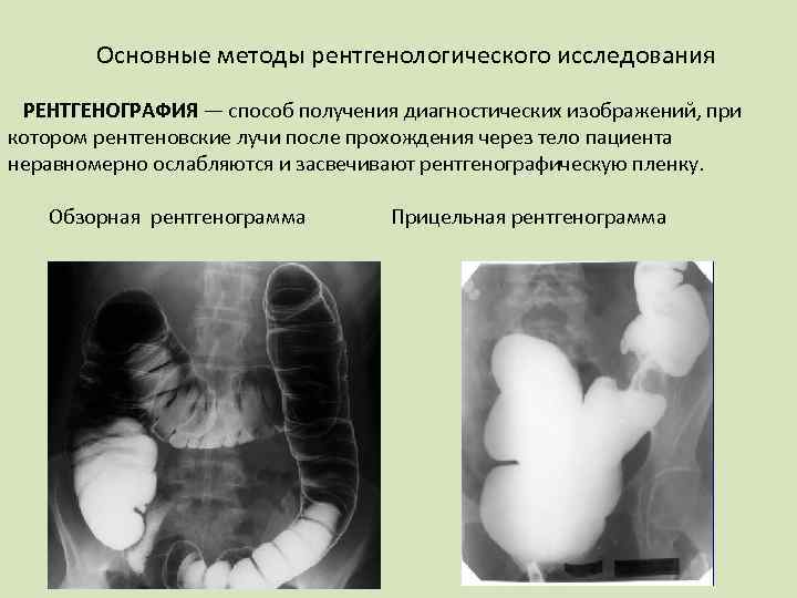 Основные методы рентгенологического исследования РЕНТГЕНОГРАФИЯ — способ получения диагностических изображений, при котором рентгеновские лучи