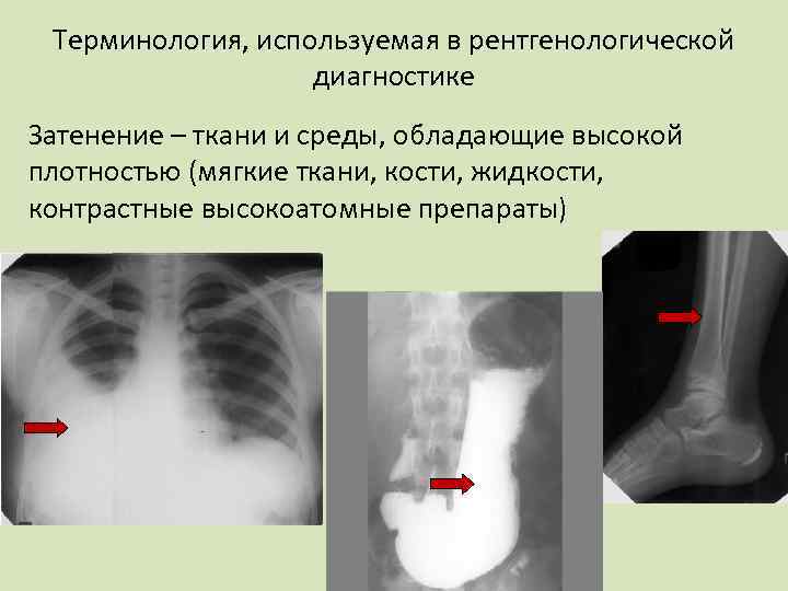 Терминология, используемая в рентгенологической диагностике Затенение – ткани и среды, обладающие высокой плотностью (мягкие