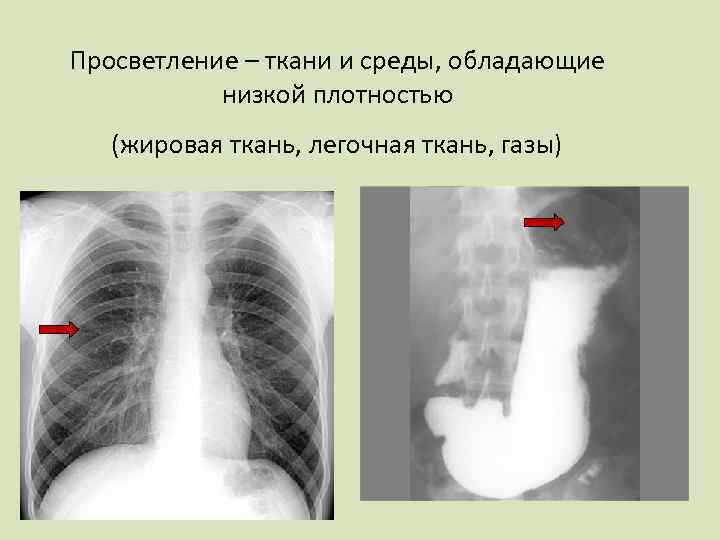 Просветление – ткани и среды, обладающие низкой плотностью (жировая ткань, легочная ткань, газы) 