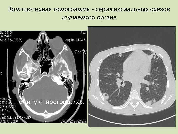 Компьютерная томограмма - серия аксиальных срезов изучаемого органа по типу «пироговских» . 