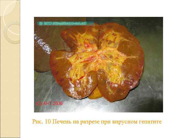 Рис. 10 Печень на разрезе при вирусном гепатите 